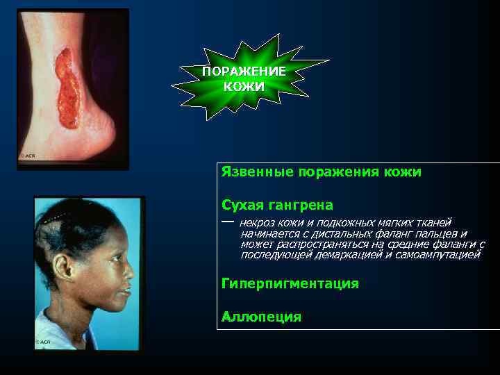 ПОРАЖЕНИЕ КОЖИ Язвенные поражения кожи Сухая гангрена — некроз кожи и подкожных мягких тканей