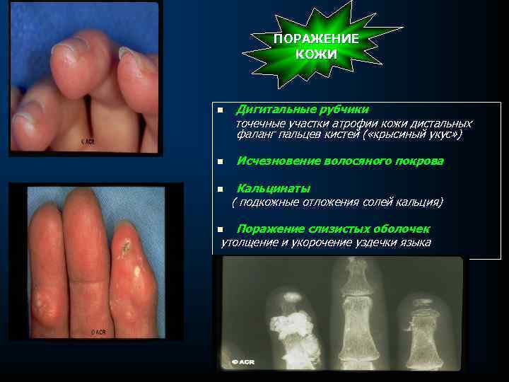 ПОРАЖЕНИЕ КОЖИ n n n Дигитальные рубчики точечные участки атрофии кожи дистальных фаланг пальцев