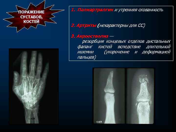 ПОРАЖЕНИЕ СУСТАВОВ, КОСТЕЙ 1. Полиартралгии и утренняя скованность 2. Артриты (нехарактерны для СС) 3.