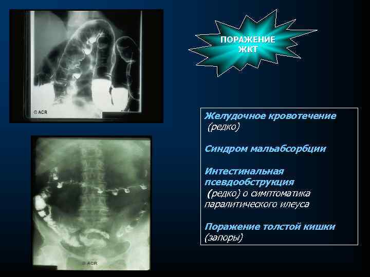 ПОРАЖЕНИЕ ЖКТ Желудочное кровотечение (редко) Синдром мальабсорбции Интестинальная псевдообструкция (редко) о симптоматика паралитического илеуса