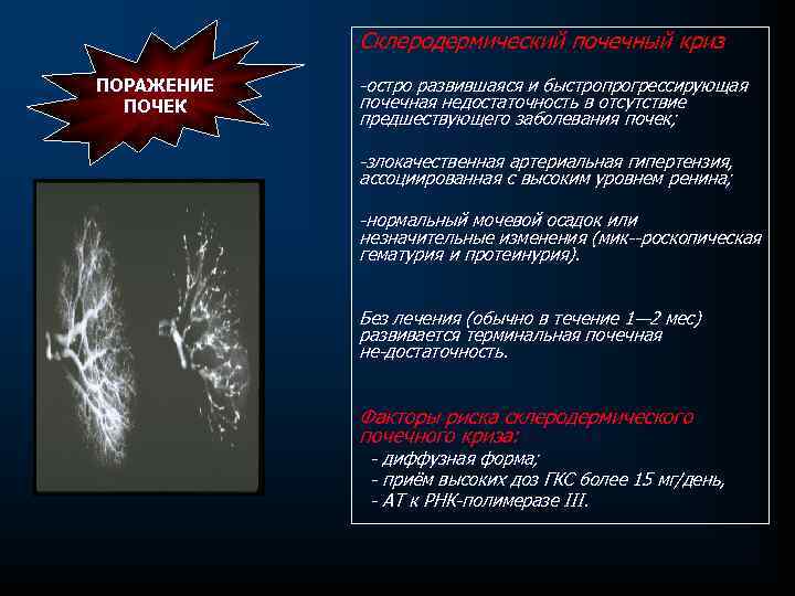 Склеродермический почечный криз ПОРАЖЕНИЕ ПОЧЕК остро развившаяся и быстропрогрессирующая почечная недостаточность в отсутствие предшествующего