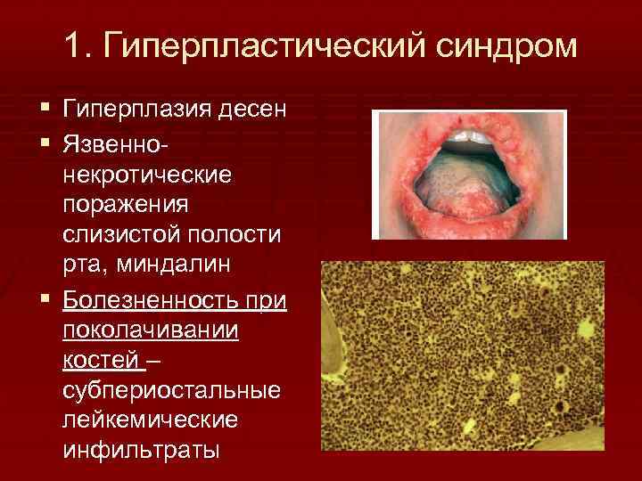 1. Гиперпластический синдром § Гиперплазия десен § Язвенно некротические поражения слизистой полости рта, миндалин