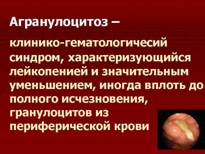 Агранулоцитоз – клинико-гематологичесий синдром, характеризующийся лейкопенией и значительным уменьшением, иногда вплоть до полного исчезновения,