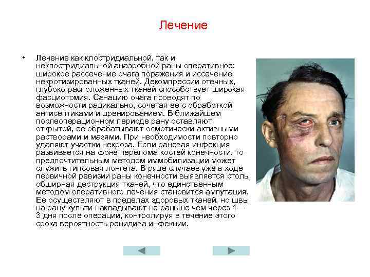 Лечение • Лечение как клостридиальной, так и неклостридиальной анаэробной раны оперативное: широкое рассечение очага