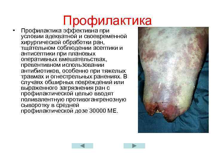 Профилактика • Профилактика эффективна при условии адекватной и своевременной хирургической обработки ран, тщательном соблюдении