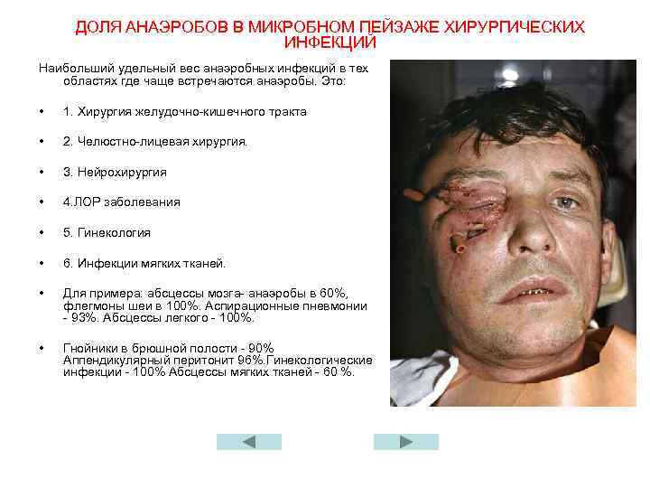 ДОЛЯ АНАЭРОБОВ В МИКРОБНОМ ПЕЙЗАЖЕ ХИРУРГИЧЕСКИХ ИНФЕКЦИЙ Наибольший удельный вес анаэробных инфекций в тех