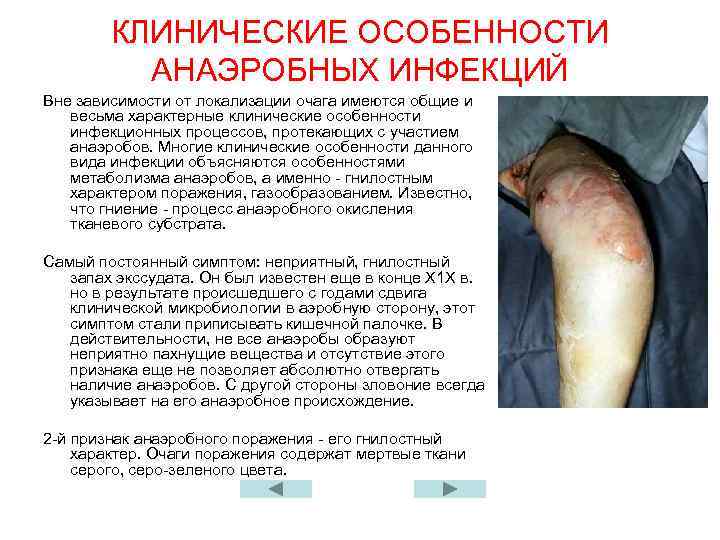 КЛИНИЧЕСКИЕ ОСОБЕННОСТИ АНАЭРОБНЫХ ИНФЕКЦИЙ Вне зависимости от локализации очага имеются общие и весьма характерные