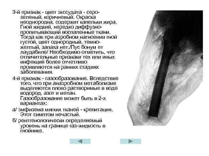 3 -й признак - цвет экссудата - серозеленый, коричневый. Окраска неоднородна, содержит капельки жира.