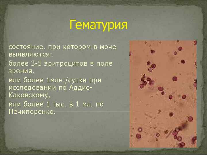 Появление эритроцитов в моче. Макрогематурия эритроциты в моче. Эритроциты в поле зрения в моче. Микрогематурия анализ мочи. Эритроциты в моче 2 3 в поле зрения.