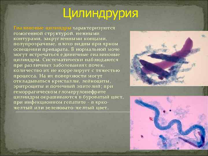 Цилиндрурия в моче. Цилиндрурия наблюдается при. Цилиндрурия характерна для заболевания. Цилиндрурия диагностическое значение.