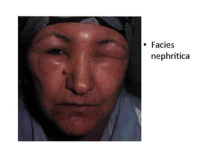  • Facies nephritica 