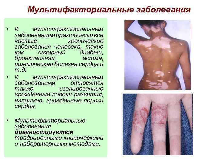 Мультифакториальные заболевания • К мультифакториальным заболеваниям практически все частые хронические заболевания человека, такие как