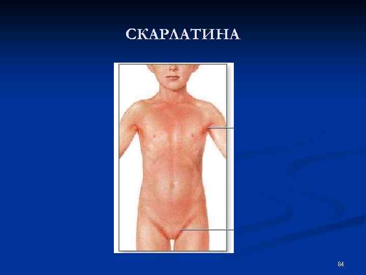 СКАРЛАТИНА 84 