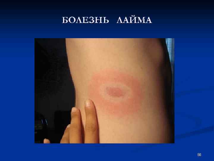 БОЛЕЗНЬ ЛАЙМА 86 