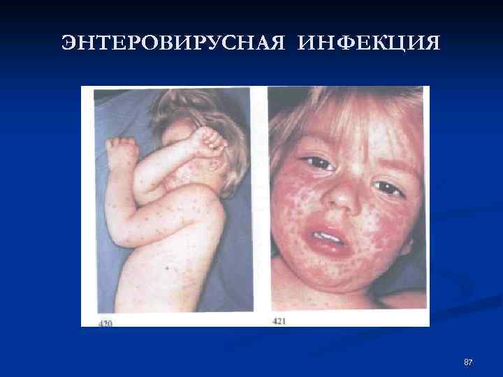 ЭНТЕРОВИРУСНАЯ ИНФЕКЦИЯ 87 
