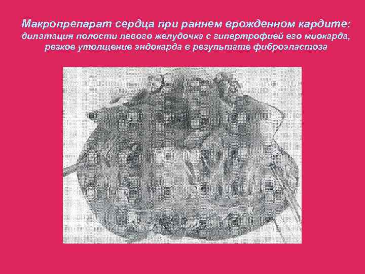 Макропрепарат сердца при раннем врожденном кардите: дилатация полости левого желудочка с гипертрофией его миокарда,
