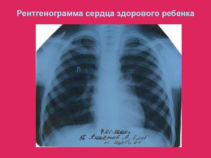 Рентгенограмма сердца здорового ребенка 