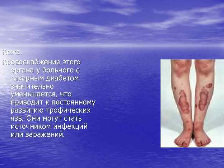 Кожа. Кровоснабжение этого органа у больного с сахарным диабетом значительно уменьшается, что приводит к