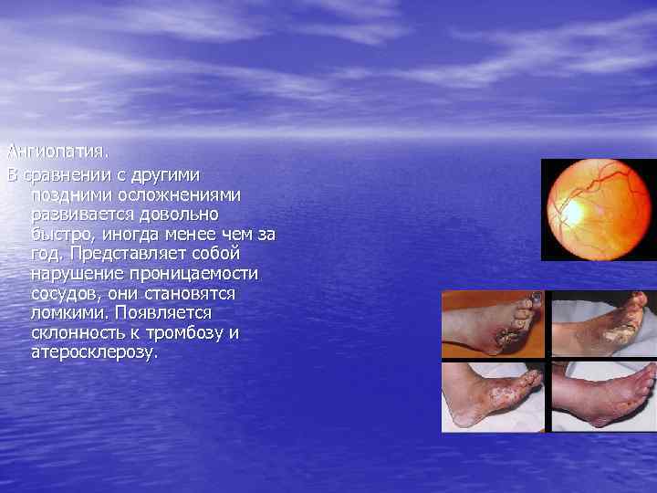 Ангиопатия. В сравнении с другими поздними осложнениями развивается довольно быстро, иногда менее чем за