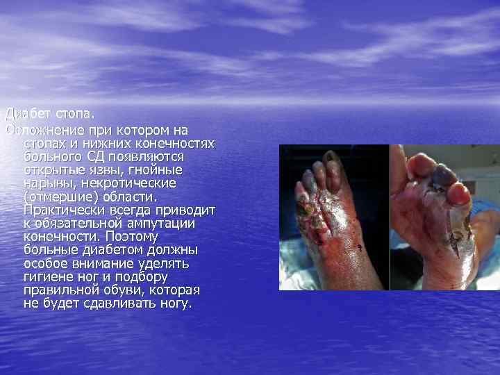 Диабет стопа. Осложнение при котором на стопах и нижних конечностях больного СД появляются открытые