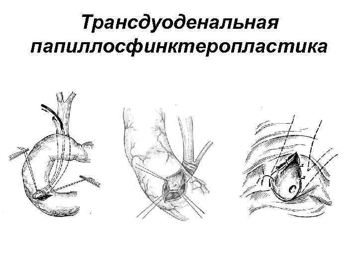 Эндоскопическая папиллосфинктеротомия презентация