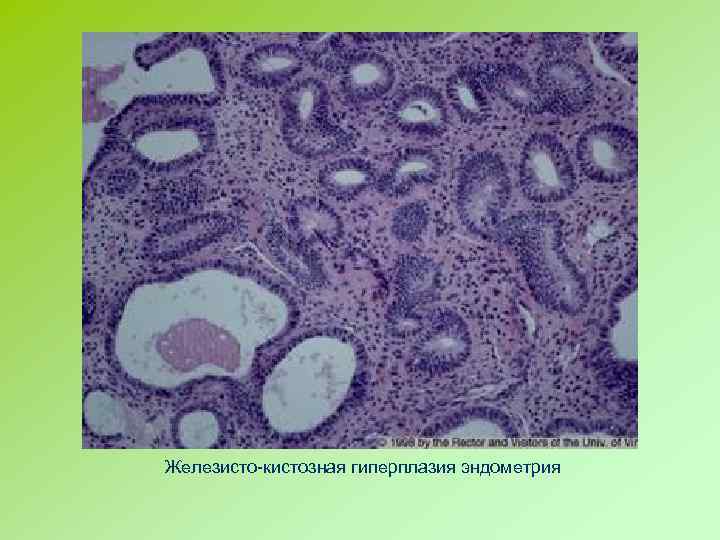 Железисто-кистозная гиперплазия эндометрия 