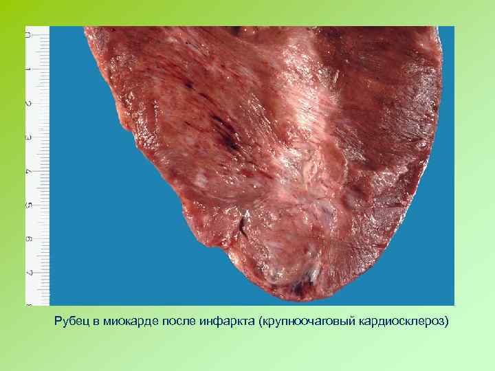 Рубец в миокарде после инфаркта (крупноочаговый кардиосклероз) 