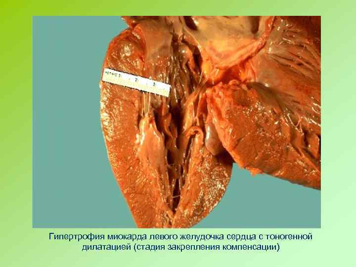 Гипертрофия миокарда левого желудочка сердца с тоногенной дилатацией (стадия закрепления компенсации) 