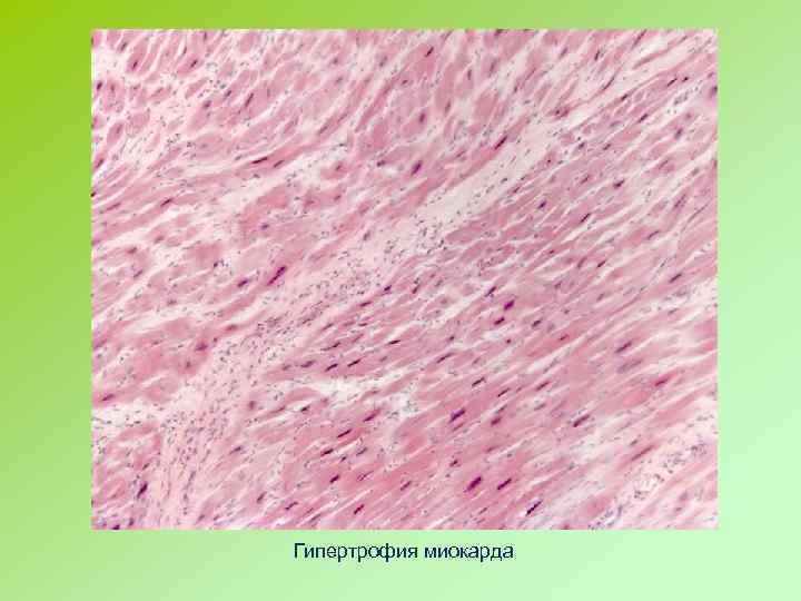 Гипертрофия миокарда 