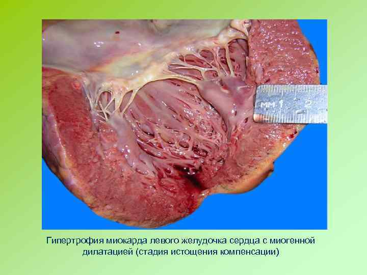 Гипертрофия миокарда левого желудочка сердца с миогенной дилатацией (стадия истощения компенсации) 