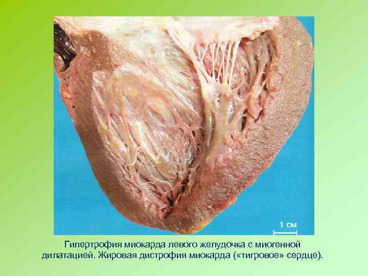 Гипертрофия миокарда левого желудочка с миогенной дилатацией. Жировая дистрофия миокарда ( «тигровое» сердце). 