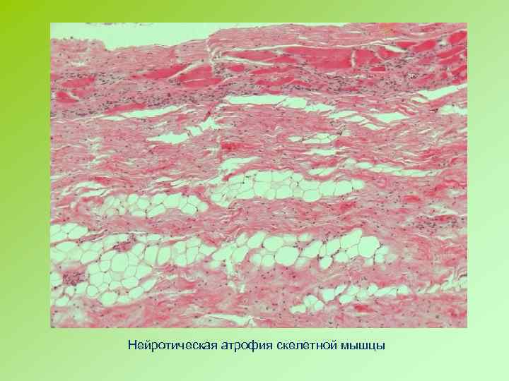 Нейротическая атрофия скелетной мышцы 