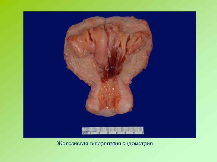 Железистая гиперплазия эндометрия 