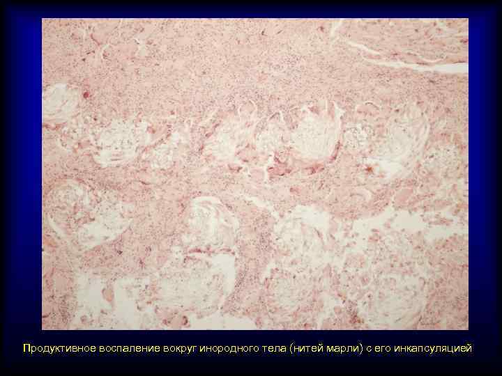 Продуктивное воспаление вокруг инородного тела (нитей марли) с его инкапсуляцией 