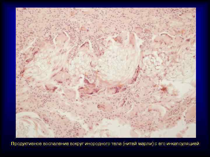 Продуктивное воспаление вокруг инородного тела (нитей марли) с его инкапсуляцией 