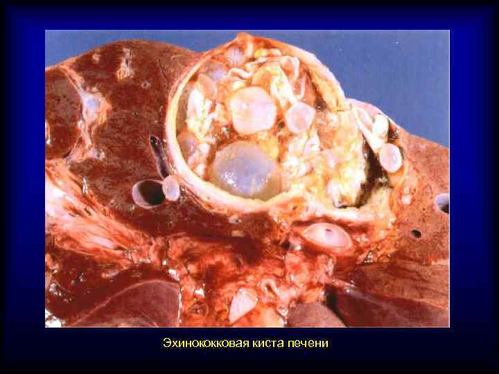 Эхинококковая киста печени 
