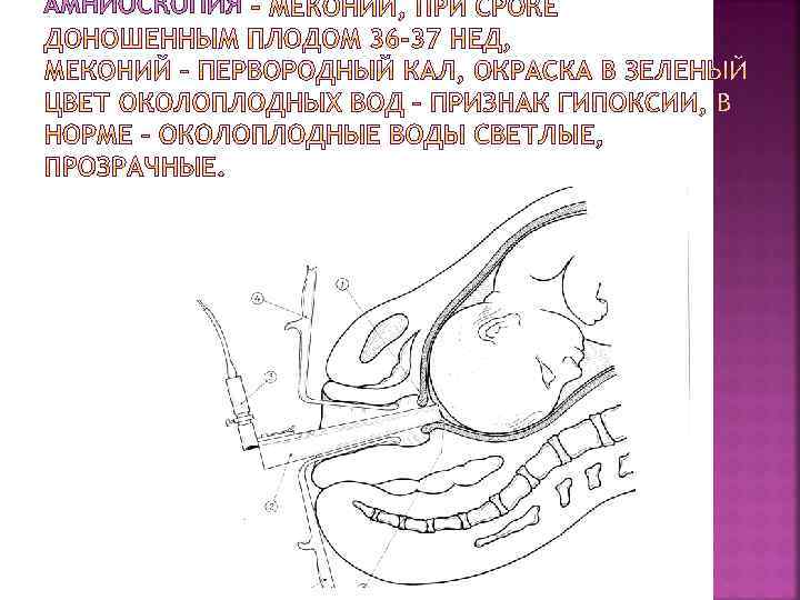 АМНИОСКОПИЯ 