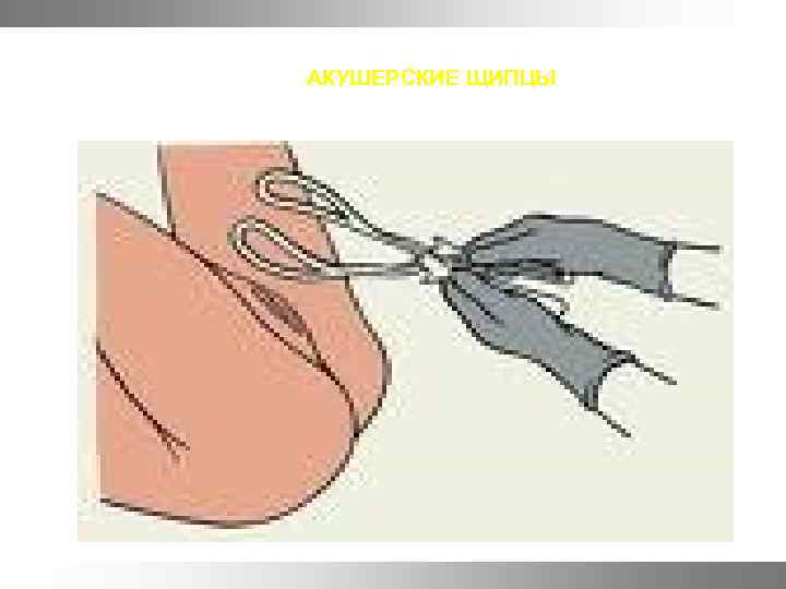 АКУШЕРСКИЕ ЩИПЦЫ 
