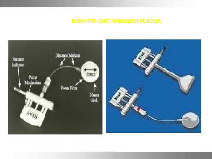 Вакуум экстракция плода презентация