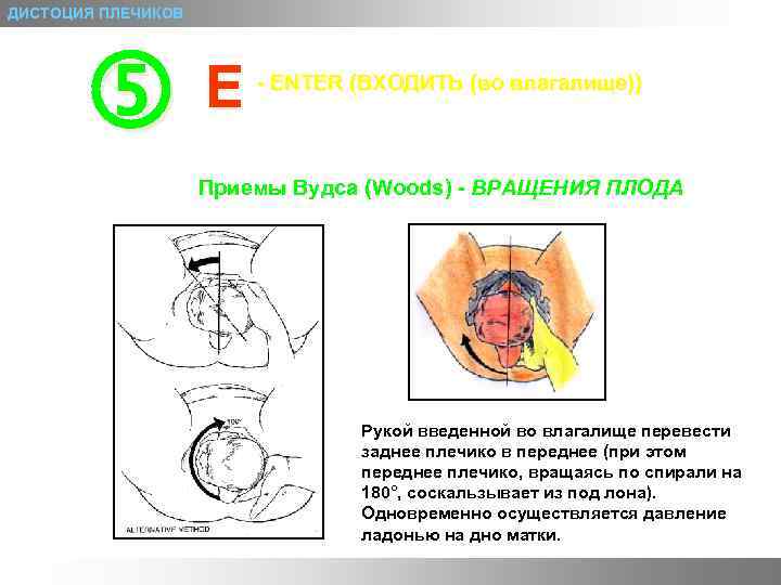 ДИСТОЦИЯ ПЛЕЧИКОВ E - ENTER (ВХОДИТЬ (во влагалище)) Приемы Вудса (Woods) - ВРАЩЕНИЯ ПЛОДА