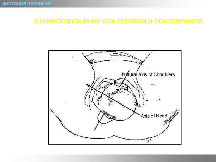 ДИСТОЦИЯ ПЛЕЧИКОВ ВЗАИМООТНОШЕНИЕ ОСИ ГОЛОВКИ И ОСИ ПЛЕЧИКОВ 