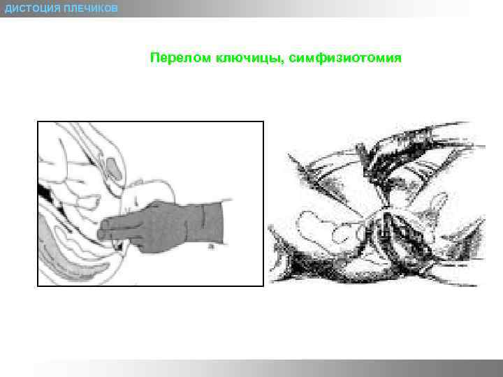 ДИСТОЦИЯ ПЛЕЧИКОВ Перелом ключицы, симфизиотомия 