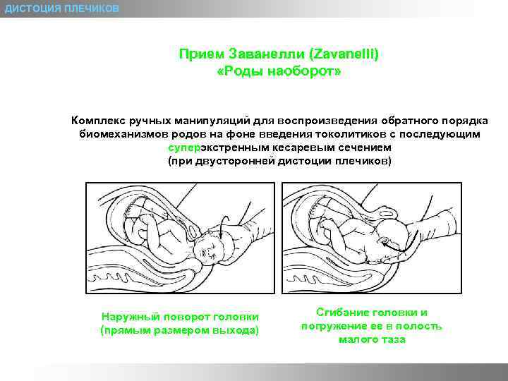 ДИСТОЦИЯ ПЛЕЧИКОВ Прием Заванелли (Zavanelli) «Роды наоборот» Комплекс ручных манипуляций для воспроизведения обратного порядка