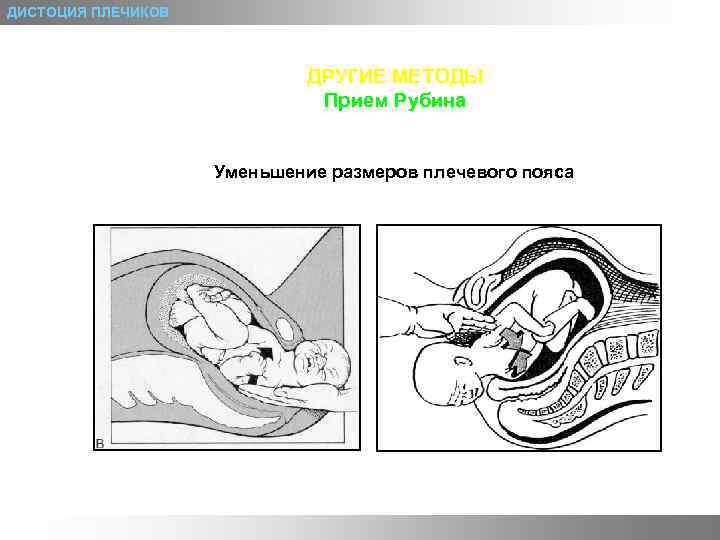 ДИСТОЦИЯ ПЛЕЧИКОВ ДРУГИЕ МЕТОДЫ Прием Рубина Уменьшение размеров плечевого пояса 