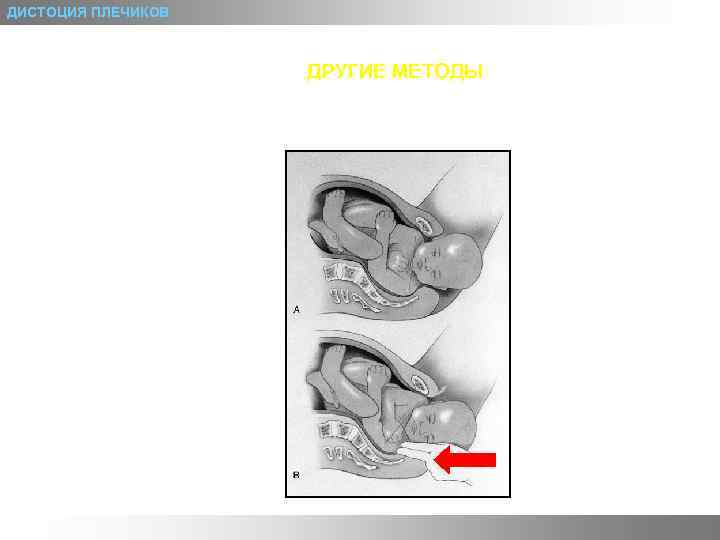 ДИСТОЦИЯ ПЛЕЧИКОВ ДРУГИЕ МЕТОДЫ 