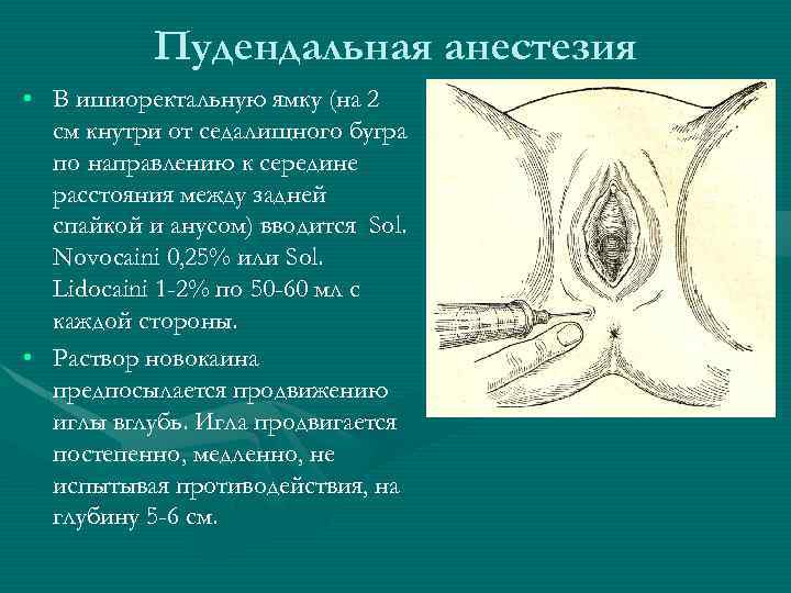 Пудендальная анестезия • В ишиоректальную ямку (на 2 см кнутри от седалищного бугра по