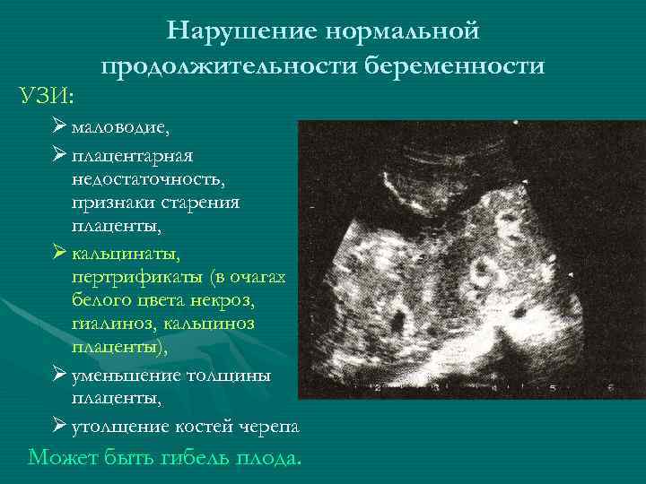 УЗИ: Нарушение нормальной продолжительности беременности Ø маловодие, Ø плацентарная недостаточность, признаки старения плаценты, Ø