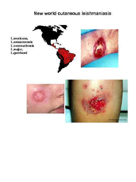 New world cutaneous leishmaniasis L. mexicana, L. amasonensis L. venesuelensis L. major, L. garnhami