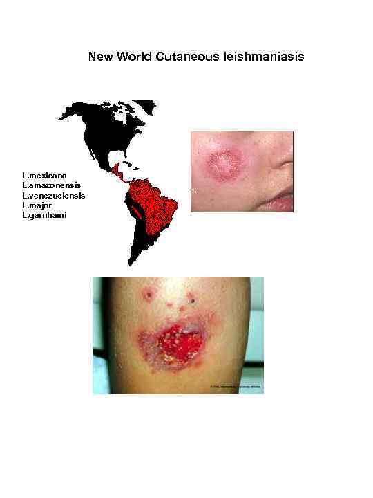 New World Cutaneous leishmaniasis L. mexicana L. amazonensis L. venezuelensis L. major L. garnhami