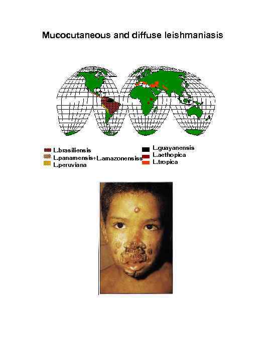 Mucocutaneous and diffuse leishmaniasis L. brasiliensis L. panamensis+L. amazonensiss L. peruviana L. guayanensis L.